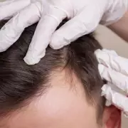 Balding Man's Dramatic Haircut Transformation Earns 'Million Times Better' Praise