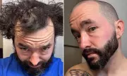 Baldness Support Forum Goes Viral as Men Share Shaved Head Transformations