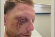 Ben Stokes Recovers from Surgery After Cricket Ball Facial Injury