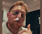 Ben Stokes Shares Bruised Face Photo After Cricket Ball Injury