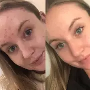 Boots' 18p 'Overnight Miracle' Pimple Patches Hailed as Market's Best for Breakouts