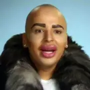 Britain's 'Lip King' Jordan James Parke Dies, Family Heartbroken