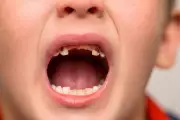 Children's Dental Crisis Deepens as Hospital Tooth Extractions Surge 14%