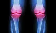 Clean Eating and Extreme Fitness Trends Fuel Rise in Youth Osteoarthritis Cases