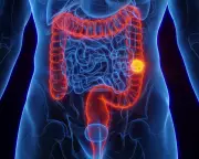 Colorectal Cancer: Rising Cases in Youth and Prevention Strategies