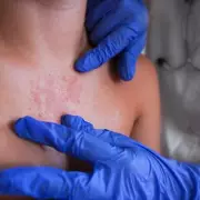 Four Victorian-Era Diseases Are Making a Concerning Comeback in Modern Britain