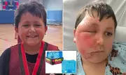 Illinois Boy Suffers Severe Burns After Dangerous TikTok Microwave Challenge