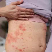 Major Measles Outbreak Hits London as Vaccination Rates Plummet