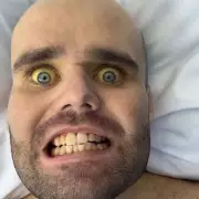 Man's Skin Turned Yellow from Vodka and Wine Binge, Now Sober and Helping Others