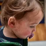 NHS Doctor Issues '90%' Measles Contagion Warning Amid UK Outbreak