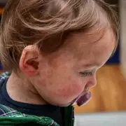 NHS Doctor Reveals Six-Month Rule for Early Measles Vaccination in Children
