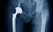 NHS Joint Replacement Crisis: Bone Cement Shortage Forces Mass Surgery Cancellations