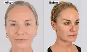 Tamzin Outhwaite Reveals £4,950 Non-Surgical Facelift Results