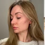 Testing Estée Lauder's New Double Wear Foundation During a Hormonal Breakout
