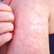 Toddler's Life-Threatening Battle with Measles After Nursery Outbreak