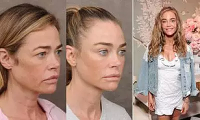 Denise Richards's Surgeon Reveals Facelift Photos Amid Divorce Drama