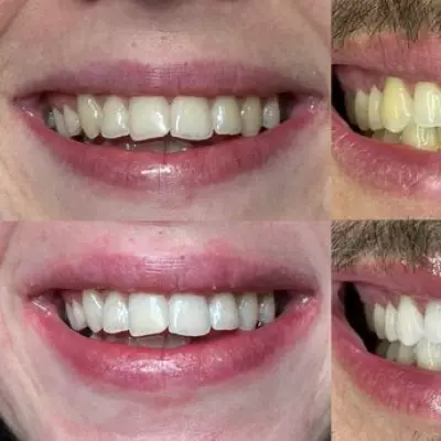 HeySmile Teeth Whitening Strips: Scientifically Proven to Brighten Smiles in Days