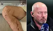 Alan Shearer Blames Potholes for Painful Cycling Accident Injuries