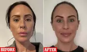 Australian Woman Defends £10k Turkish Facelift Amid Trolls' Ageing Claims