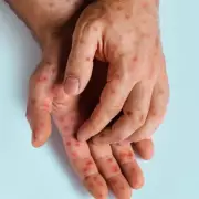 Brit Kicked Off TUI Cruise After Ringworm Mistaken for Monkeypox