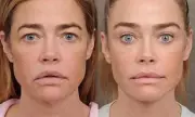 Denise Richards' Surgeon Reveals Facelift Photos and She Details Surgery Journey