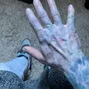 Man Rushed to Hospital After Turning Blue from Unwashed Bedsheets