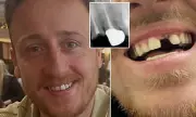 Man Wins £25,000 After Failed Veneer Treatment Forces Him to Glue Teeth