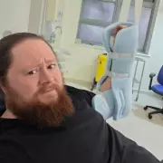 Man's Hand Swells to Bowling Ball Size After Suspected False Widow Spider Bite