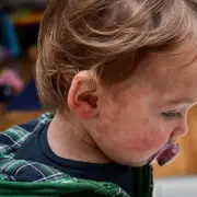 Measles Cases Surge in England, Prompting School Exclusion Warnings