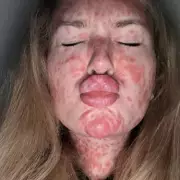 Measles Outbreak Leads to Unexpected Pregnancy After Contraceptive Patch Removal