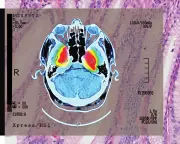 Shingles Vaccine Shows Strong Evidence of Lowering Dementia Risk, Study Finds