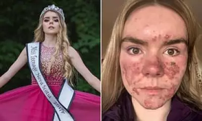 From Pageant Queen to Acne Warrior: Zoe Morgan's Journey of Self-Discovery