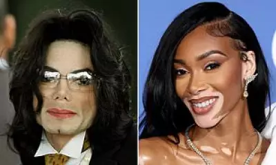 Michael Jackson Biopic Sparks New Interest in Vitiligo Condition