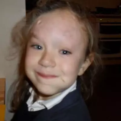 Paediatric Nurse Born with Rare Skin Condition Embraces Her Unique Look