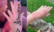Australian Mother's Bali Henna Warning After Daughter's Severe Skin Reaction