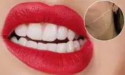 Botox for Teeth Grinding: A 24-Year-Old's Journey to Relief