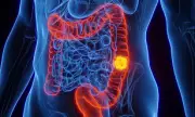Bowel Cancer Breakthrough: Immunotherapy Trial Keeps Patients Cancer-Free for Years