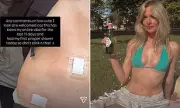 Diana Vickers Shows Bandaged Body After Mystery Health Issue