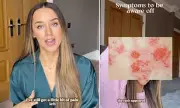 Emily MacDonagh Shares Shingles Health Update and Advice for Fans