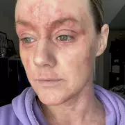 Hundreds Report Severe Skin Condition TSW as Medical Community Remains Baffled