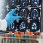 Iron Deficiency Anaemia Linked to Increased Dementia Risk, Study Finds