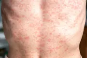Measles Outbreaks Surge in US as Vaccination Rates Decline