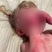 Mum's Desperate Search for Answers as Toddler's Skin Condition Leaves Bedsheets Blood-Soaked