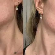 Pregnancy Acne Nightmare: A Beauty Editor's Journey to Clear Skin