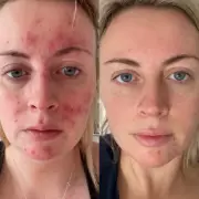 Rugby Athlete's Skin Transformation with Under £24 Skincare Solution