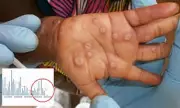 San Francisco Confirms First Case of Dangerous Mpox Strain Amid Rising US Trend