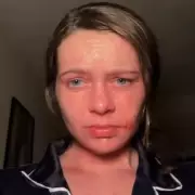 Woman, 24, Develops Sun Allergy, Burns in 15 Seconds