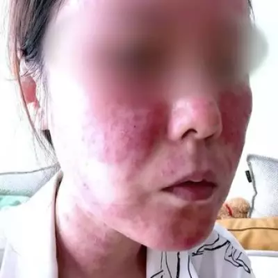 Bride Left 'Disfigured and Almost Blind' After Botched Microneedling