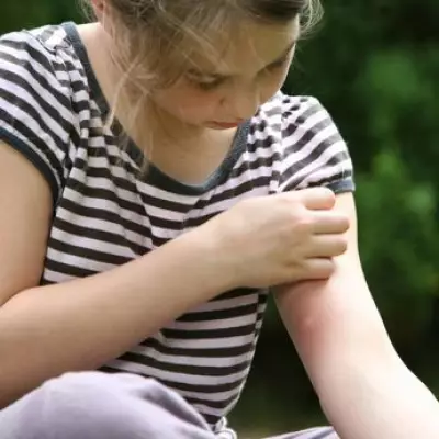 Doctor's Simple Tip to Stop Mosquito Bites Itching in Seconds