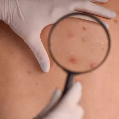NHS Urges Skin Checks as Melanoma Kills Thousands Annually in UK